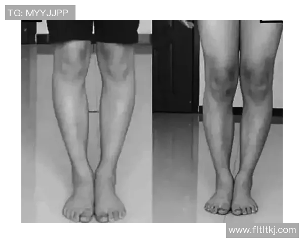 为什么很多足球运动员在长期训练后容易出现明显的O型腿问题